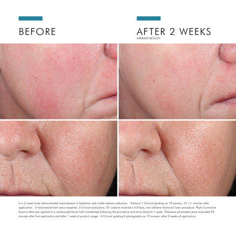 Before and after comparison of SkinCeuticals Phyto Corrective Essesence Mist results on a person's face.