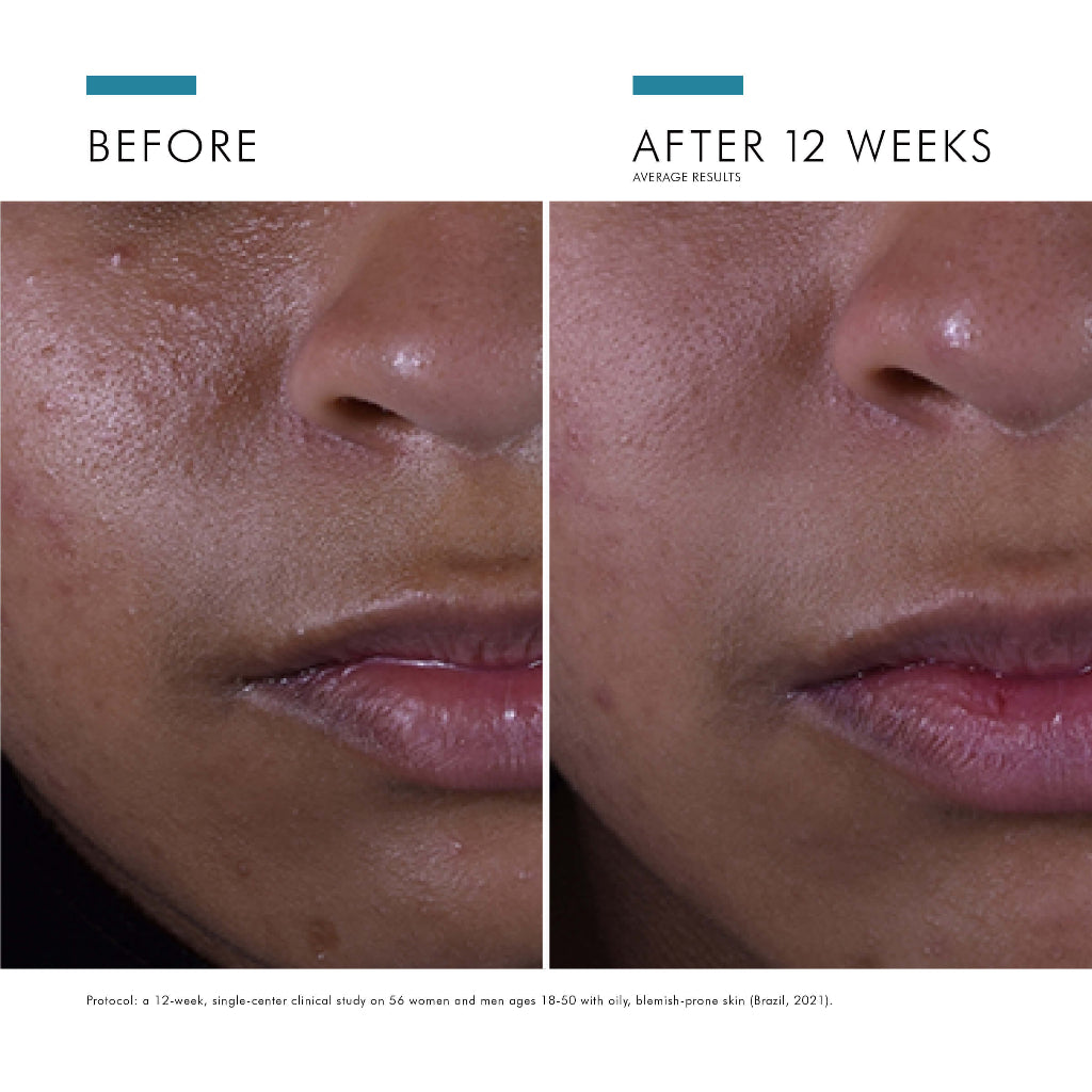 Before and after comparison of skin treatment on a person's face, showing reduced blemishes.