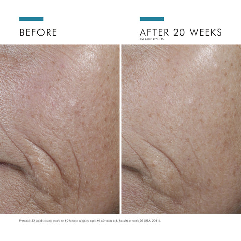 Before and after comparison of skin texture improvement over 20 weeks.