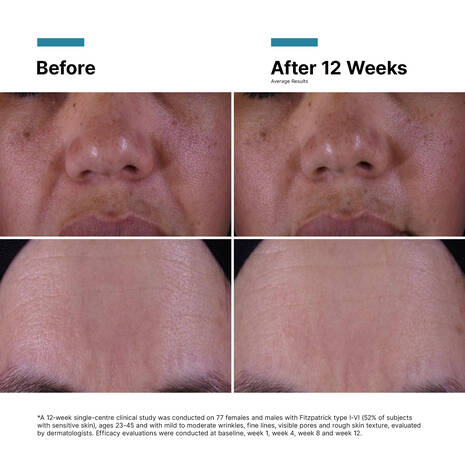 Before and after comparison of SkinCeuticals P-TIOX Cream treatment on a person's face, showing improvement over 12 weeks.