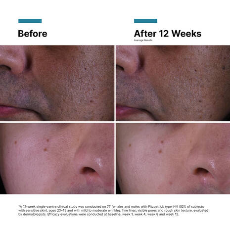 Before and after 12 weeks of SkinCeuticals P-TIOX Cream treatment comparison on a person's face.