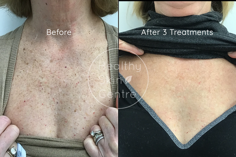 IPL + RF Skin Rejuvenation
