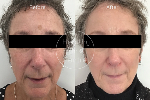 IPL + RF Skin Rejuvenation